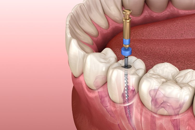 Root Canal Treatment
