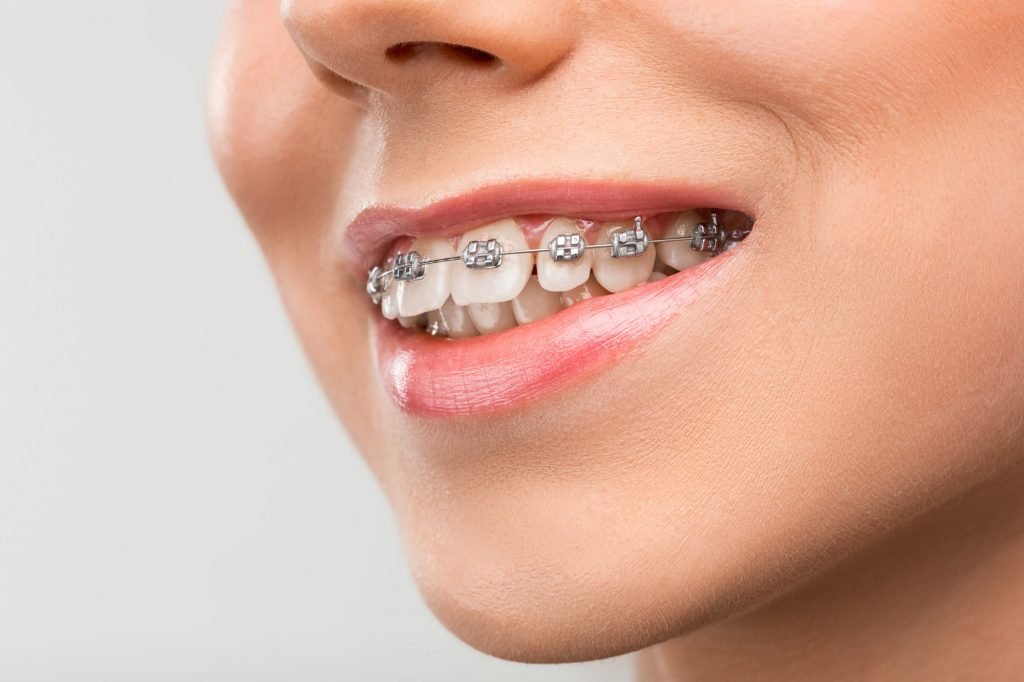 Braces (Orthodontic Treatment)