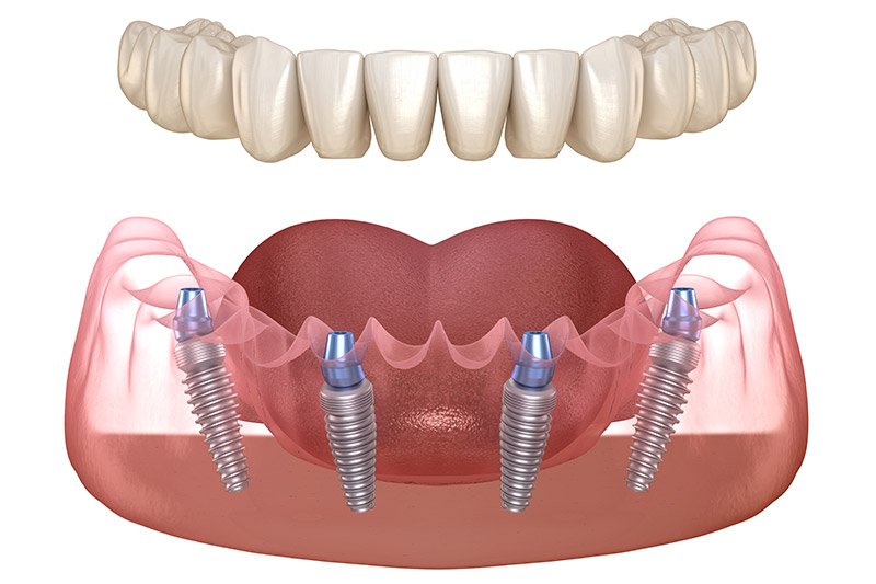 All-on-4 Dental Implants