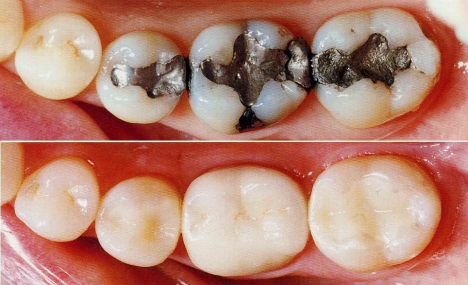 Tooth-Coloured Filling