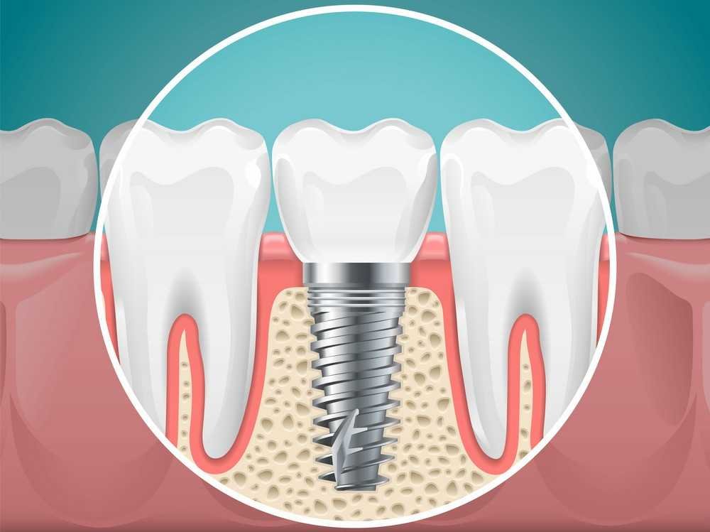 Dental Implants