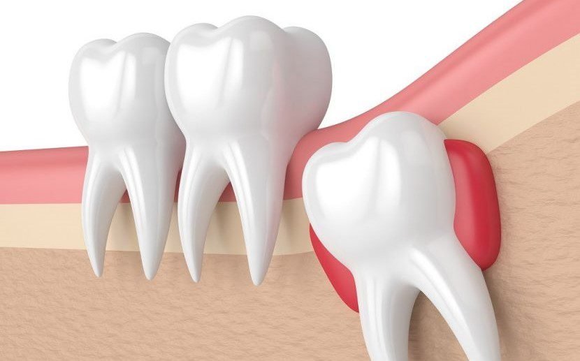 Impaction (Wisdom Tooth Removal)