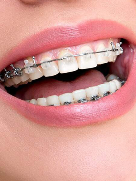 New-Ceramic-Brace New-Ceramic-Brace